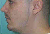 Chin Augmentation