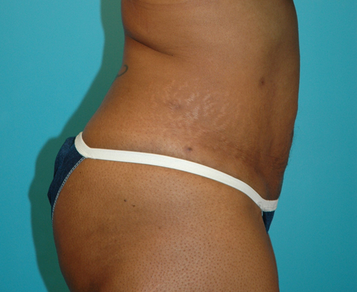 Liposuction