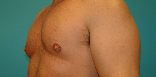 Male Gynecomastia