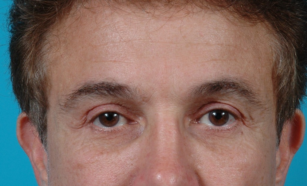 Eyelid Surgery