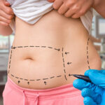 Plastic surgery doctor draw lines with marker on patient belly