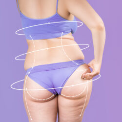 Overweight female body with painted surgical lines and arrows pre-liposuction