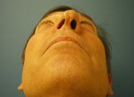 Functional Nasal Surgery