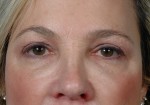 Eyelid Surgery