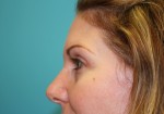 Eyelid Surgery