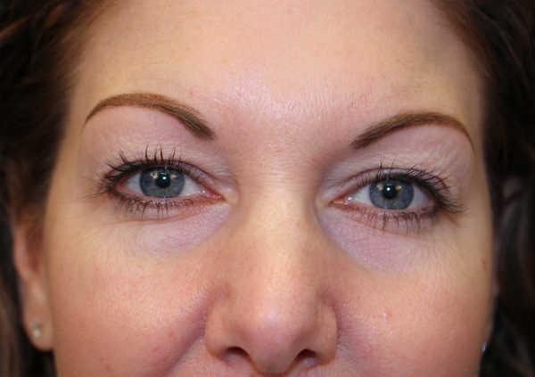 Eyelid Surgery
