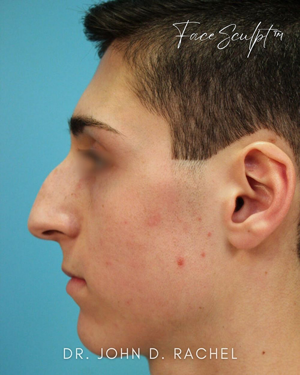 Left side profile before rhinoplasty surgery