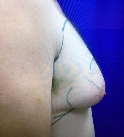 Male Gynecomastia