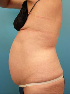 Liposuction