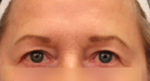 Eyelid Surgery
