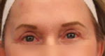 Eyelid Surgery