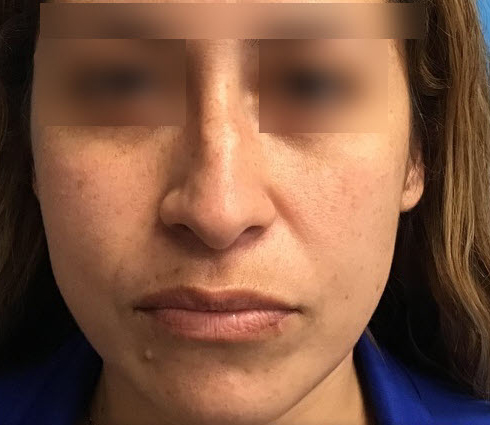 Rhinoplasty