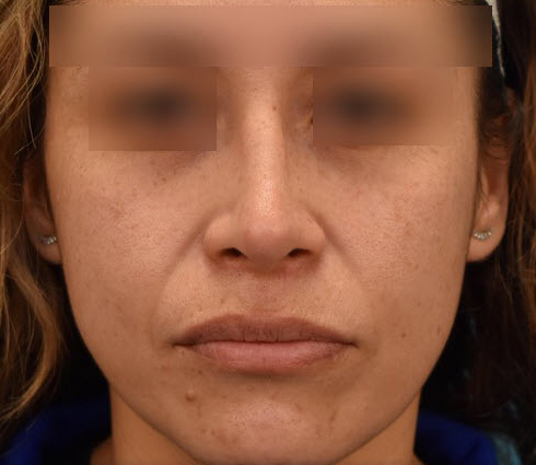 Rhinoplasty