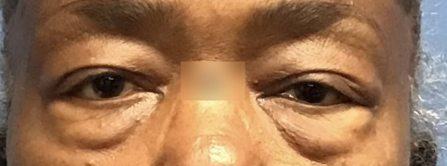 Eyelid Surgery