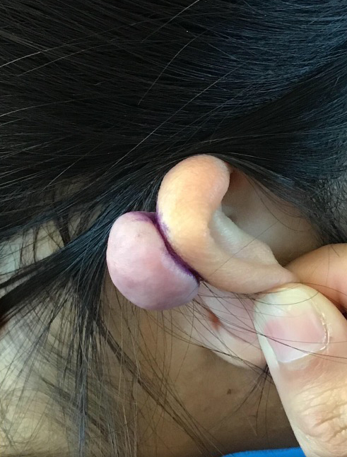 3 Keloid Removal