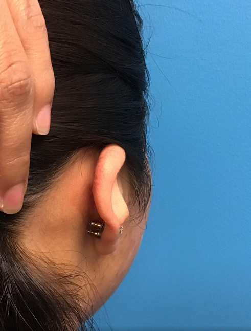 4 Keloid Removal