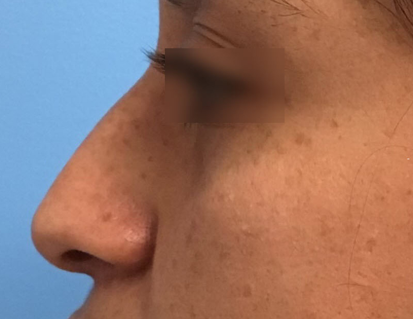 Rhinoplasty