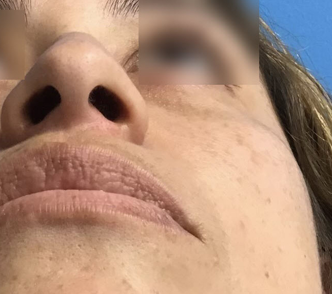 Rhinoplasty