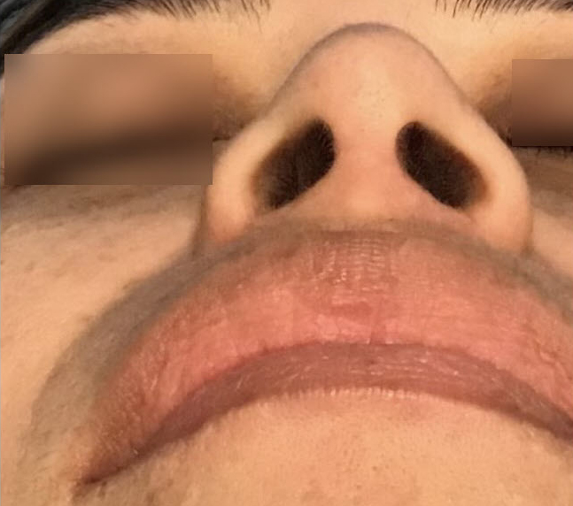 Rhinoplasty