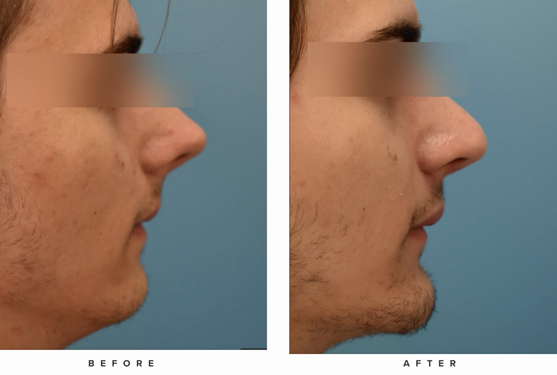 Chin Augmentation Surgery Results Chicago