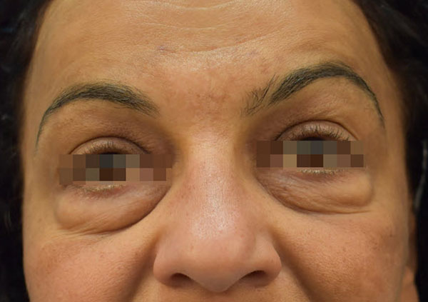 Eyelid Surgery