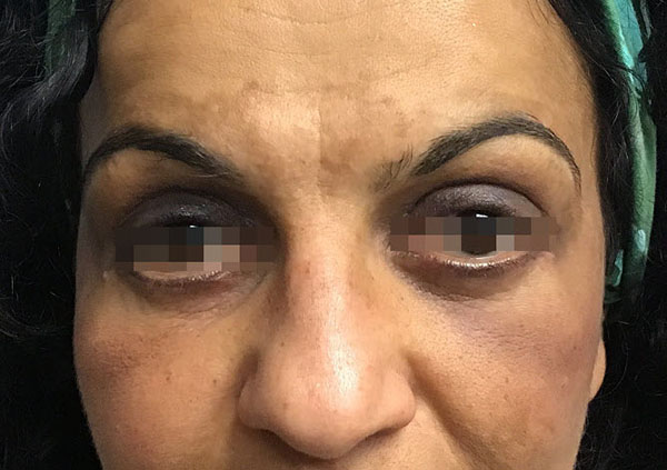 Eyelid Surgery