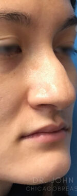 Rhinoplasty