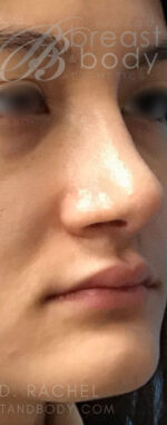 Rhinoplasty