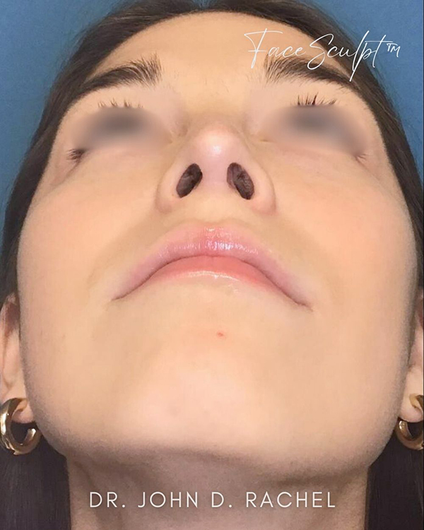 Bottom-up view after rhinoplasty surgery