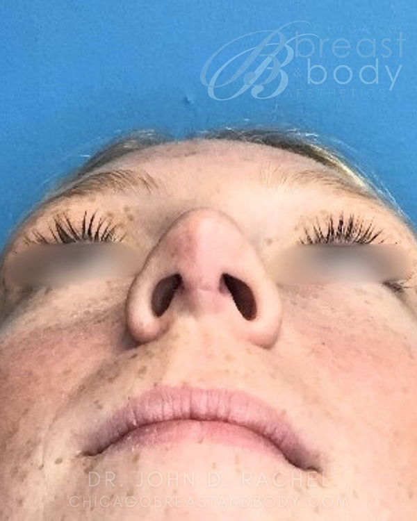 Rhinoplasty