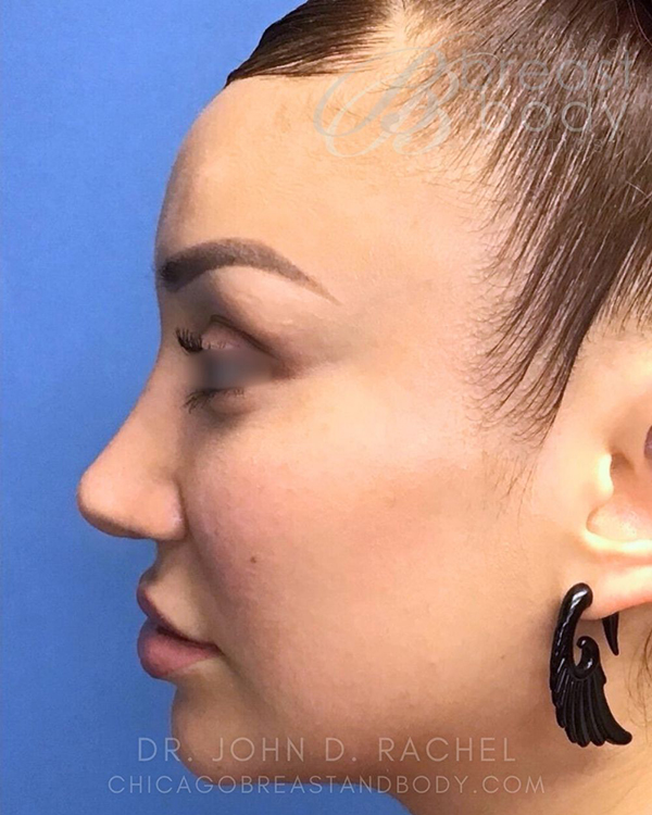 Rhinoplasty