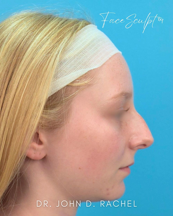 Angled view of nose pre-rhinoplasty