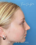 Rhinoplasty