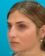 Rhinoplasty