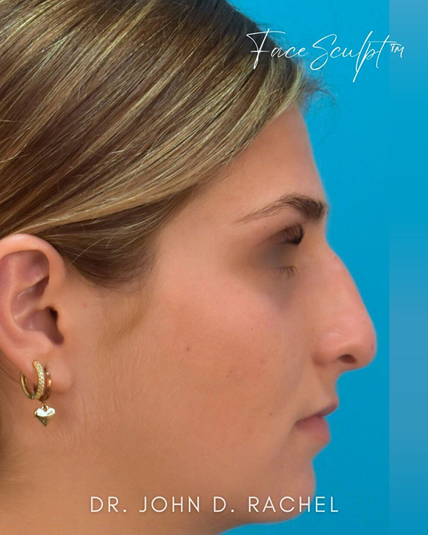 Rhinoplasty
