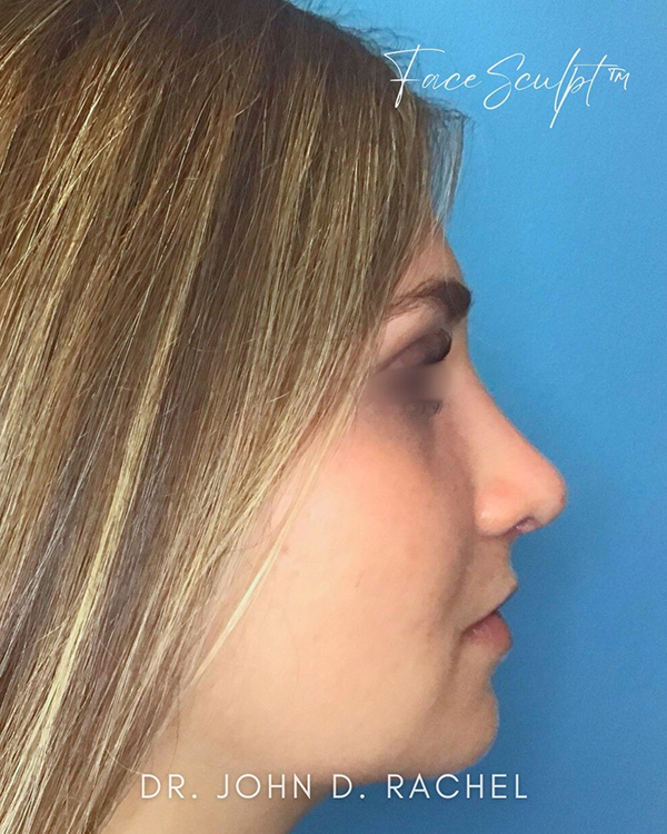 Rhinoplasty