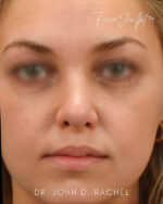 Rhinoplasty