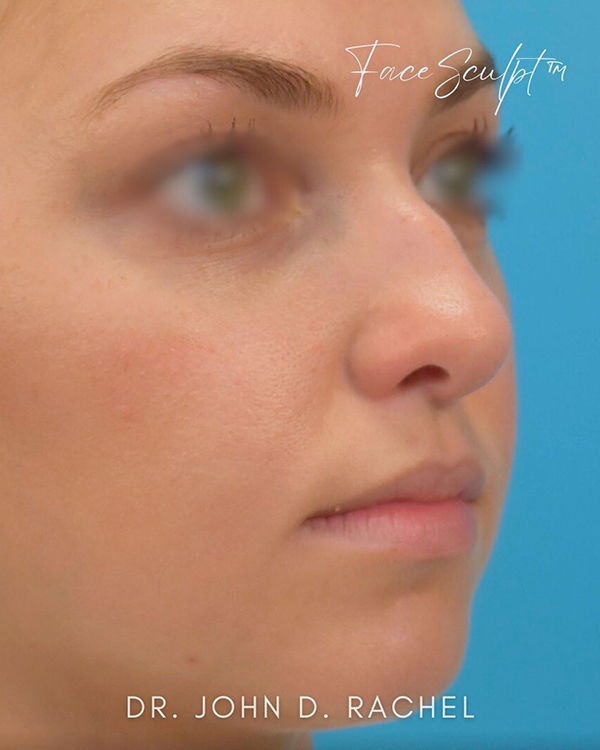 Rhinoplasty