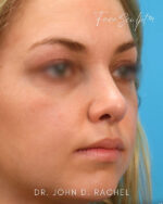 Rhinoplasty
