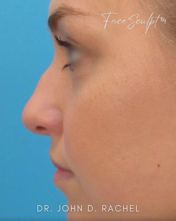Rhinoplasty