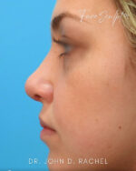 Rhinoplasty