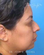 Rhinoplasty