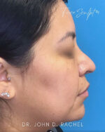 Rhinoplasty