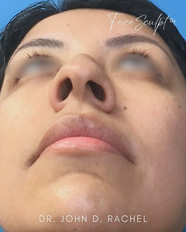 Rhinoplasty