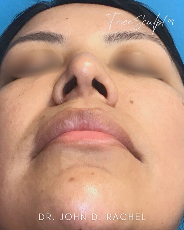 Rhinoplasty