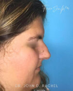 Rhinoplasty