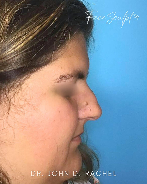 Left close-up before rhinoplasty surgery