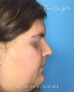 Rhinoplasty