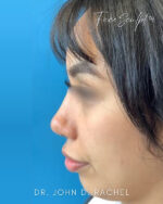 Rhinoplasty