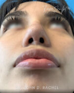 Rhinoplasty